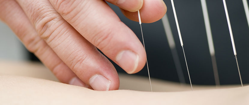 Acupuncture for Sciatica and other musculoskeletal concerns