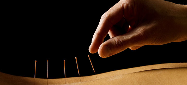 TCM (traditional Chinese medicine) acupuncture needles in back | Dr. Negin Misaghi, ND
