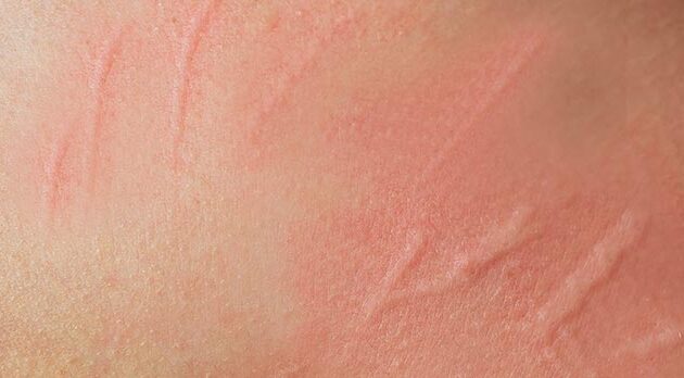 When Your Skin Writes and Your Head Hurts: